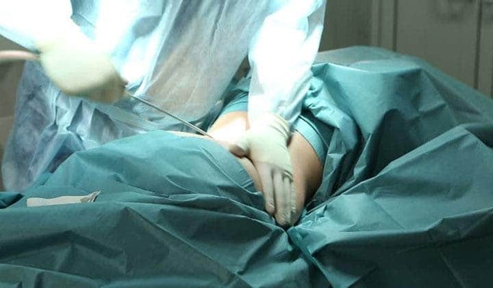 مزایای جراحی لیپوماتیک شکم در شیراز نسبت به لیپوساکشن